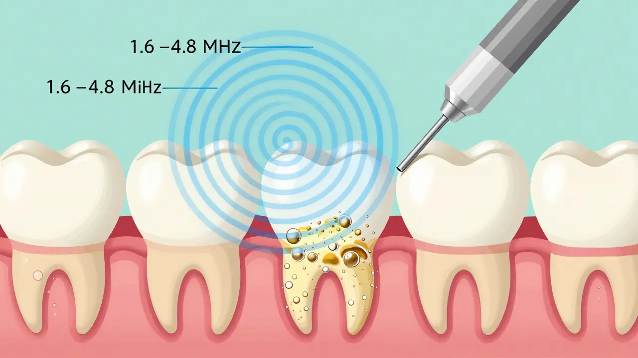 Křížový řez zubu a dásně s ultrazvukovými vlnami rozkládajícími zubní kámen.