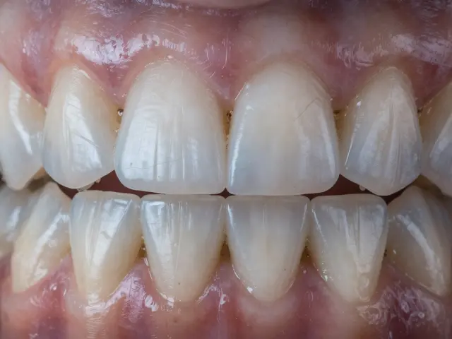 Jak zabránit prasklinám na zubech při bělení: praktické rady pro bezpečné bělení